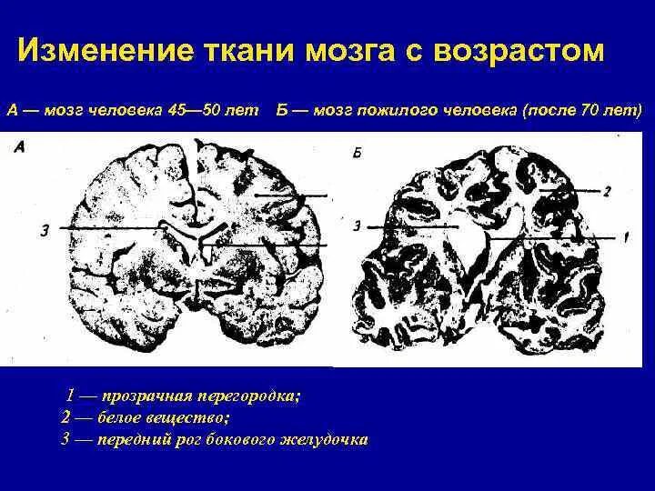 Изменение мозга человека. Мозг молодого и старого человека. Изменение головного мозга с возрастом. Структурные изменения мозга