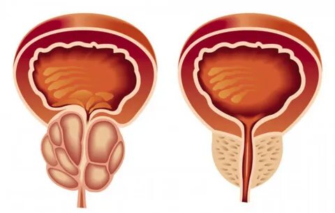 راهنمای کامل تغذیه و درمان پس از جراحی پروستات و دفع سنگ کلیه 