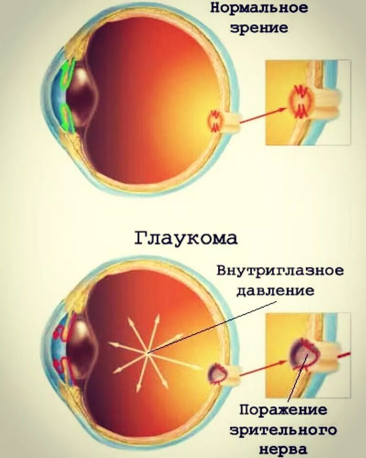 Глаукома, повышенное внутриглазное давление. Повышение глазного давления. Заболевание глаз глаукома. Глаукома внутриглазное.