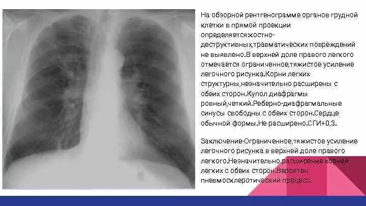 Корни малоструктурные что значит. Корень легкого на рентгенограмме. Корни легких на рентгенограмме.