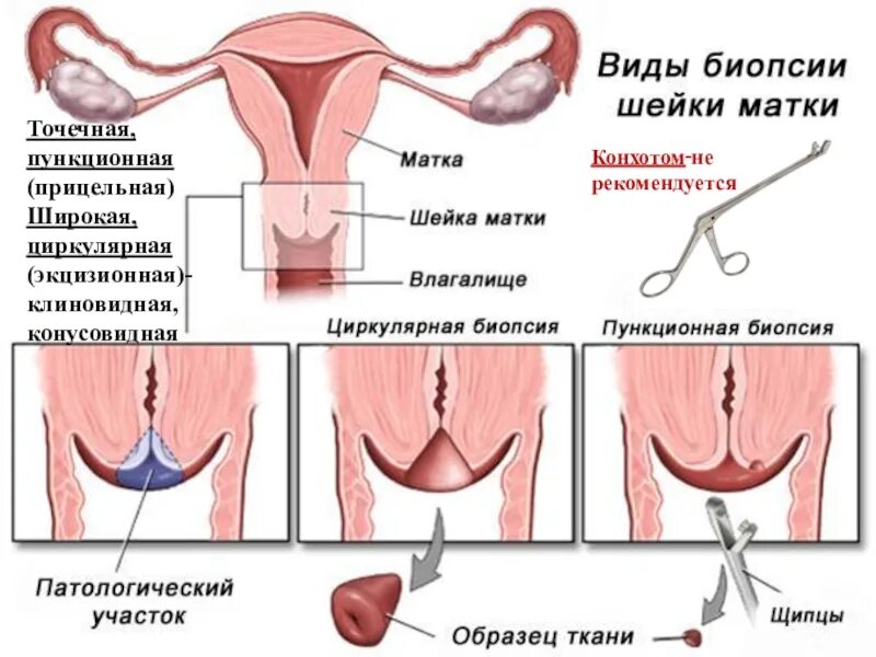 Ножевая биопсия. Точечная биопсия шейки матки. Биопсия после конизации шейки. Методика биопсии шейки матки. Пункционная биопсия матки.