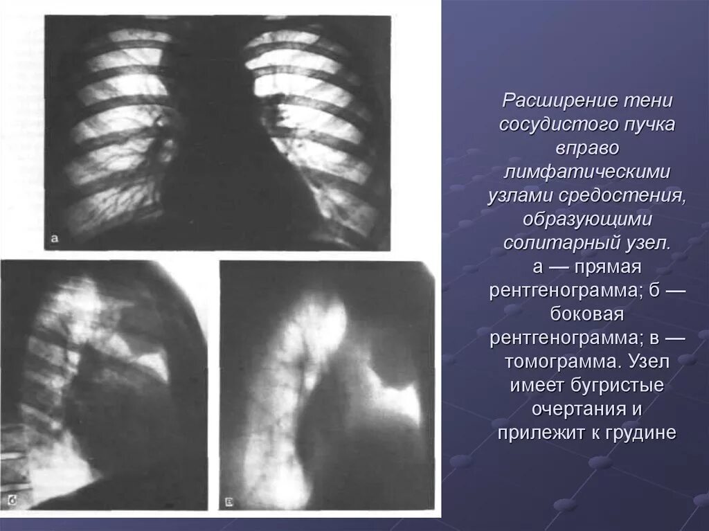 Усиление легочного сосудистого рисунка. Тень средостения расширена рентген. Затемнение на рентгеновском снимке. Расширение тени сердца рентген. Cystic fibrosis xray.