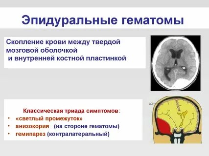 Гематома после эпидуральной