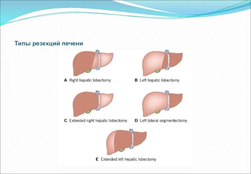 Операция резекция печени. Лобэктомия – резекция доли печени;. Типичная и атипичная резекция печени.