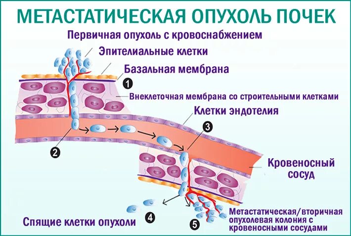 Метастазы в печени 4 стадия сколько живут. Карцинома почки метастазирование. Метастазирование опухоли почки.