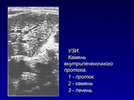 Камни в печени узи