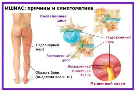 Ішыяс - запаленне сядалішчнага нерва: прычыны, сімптомы і лячэнне ў хатніх умова