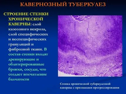 Туберкулезный сайт