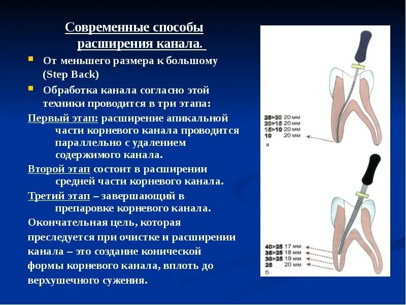 Определение корневых каналов. Расширение устьев корневых каналов ультразвуком. Техника Step back в эндодонтии. Методы расширения корневых каналов зубов. Алгоритм расширения корневых каналов.
