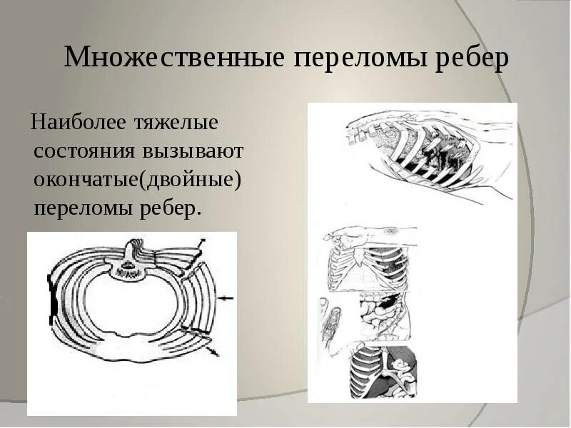 Множественные ребра. Множественные переломы ребер. окончатые переломы ребер. двойные окончатые переломы ребер.