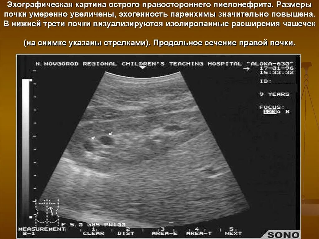 Поджелудочная железа узи эхогенность повышена. Липоматоз поджелудочной железы на УЗИ. Липоматоза поджелудочной железы на УЗИ. Повышение эхоплотности паренхимы почек. Повышение эхогенности почек на УЗИ.