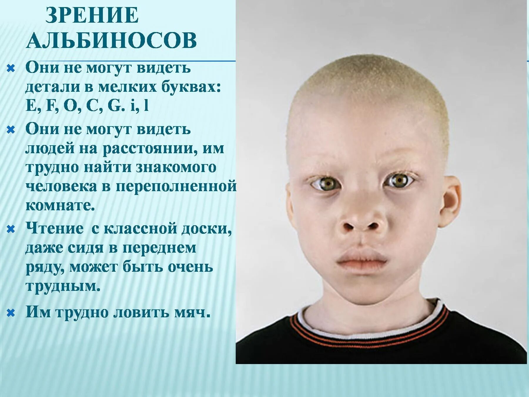 Появление в потомстве альбиноса. Альбинизм. Альбинизм причины болезни. Наследственная болезнь альбинизм.