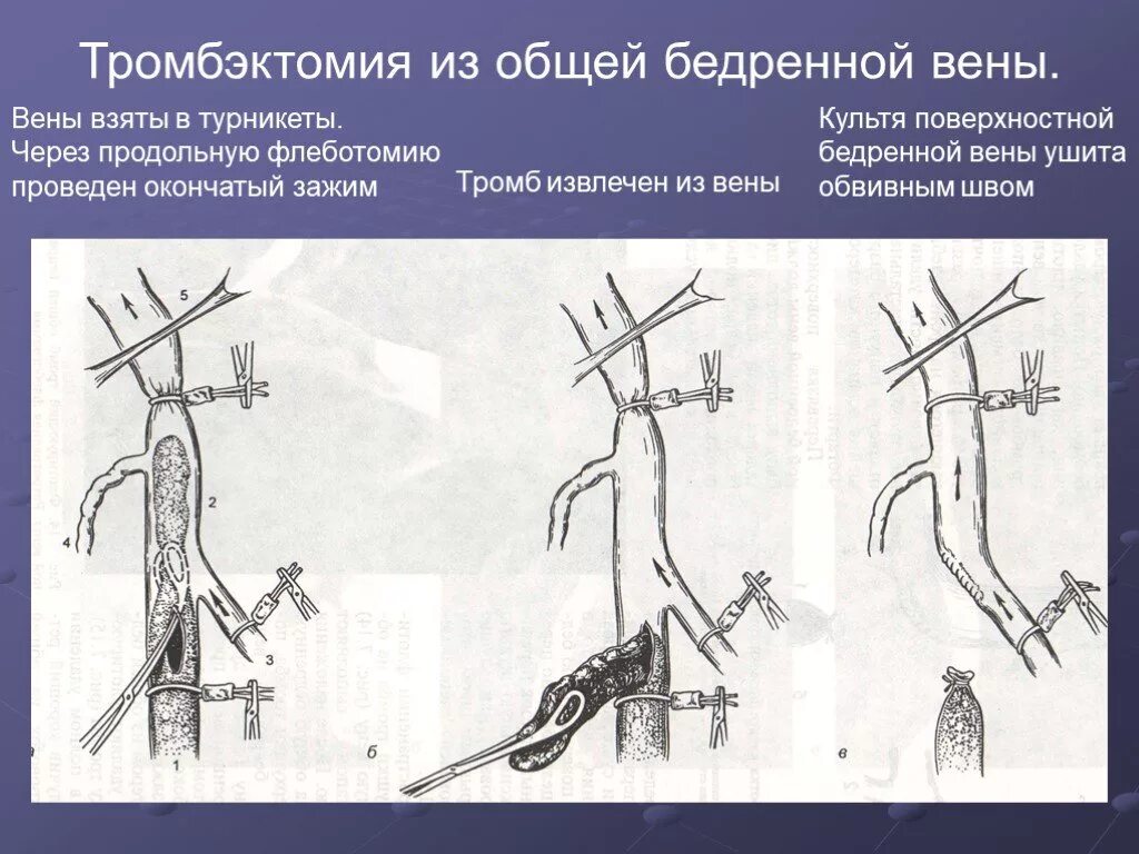 Артерия тромб удаление