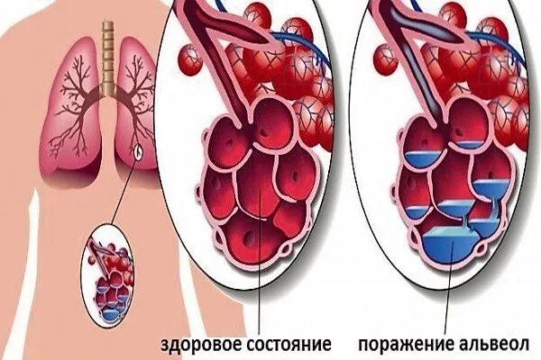 Легкие заполнены жидкостью. Воспаление альвеол легких. Жидкость в альвеолах легких. Альвеолы заполнены жидкостью.