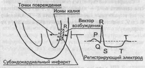 Субэндокардиальный инфаркт