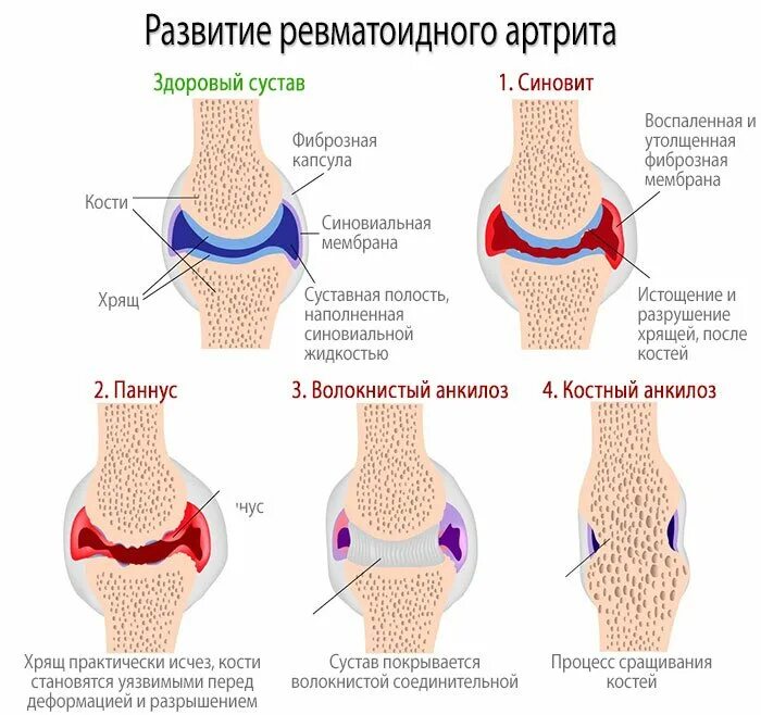 Болезни суставов температура. Ревматоидный артрит и остеоартрит. Ревматоидный артрит ранняя стадия. Системные проявления ревматоидного артрита. Дебют ревматоидного артрита.