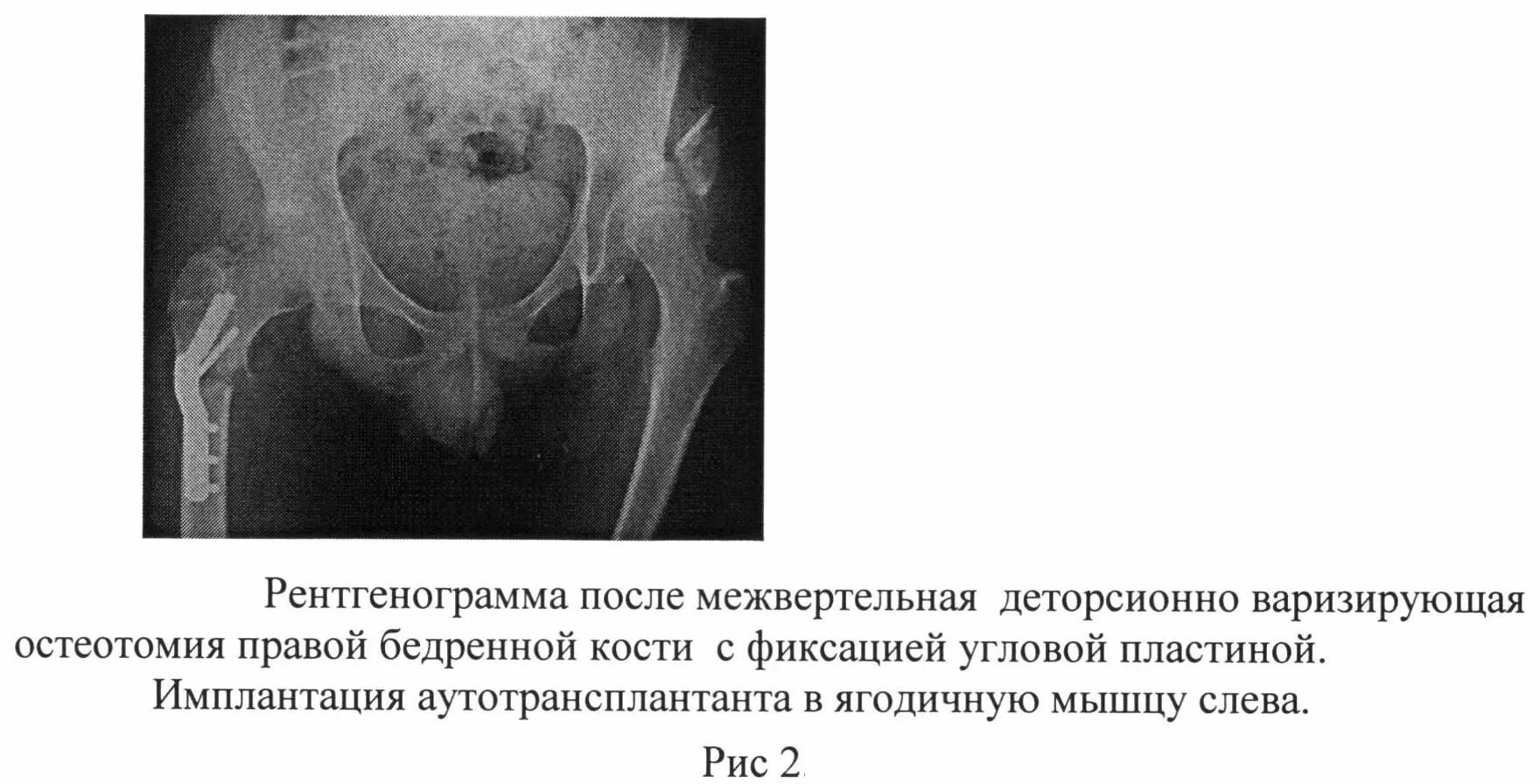 Наличия дисплазии. Седловидная дисплазия Атланта. Ацетабулопластика тазобедренного сустава. Эндометриальная дисплазия. Остеотомия таза при дисплазии.