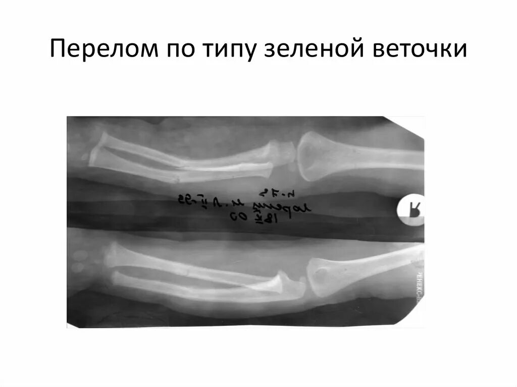 6 недель перелом. Перелом лучевой кости по типу зеленой ветки. Перелом лучевой кости по типу зеленой веточки. Перелом ключицы по типу зеленой веточки. Перелом ключицы по зеленой ветке.