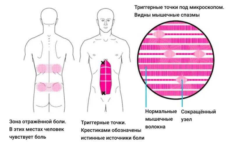 Триггерные точки это простыми словами. Триггерные точки. Миофасциальный синдром. Зоны отраженной боли. Триггерные зоны.