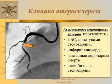 Атеросклероз коронарных артерий код