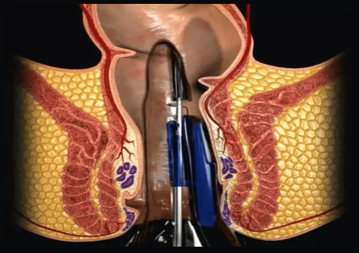 Тромбированный геморрой. Тромбоз геморроидального узла. Тромбэктомия геморроидального. Расширив проход
