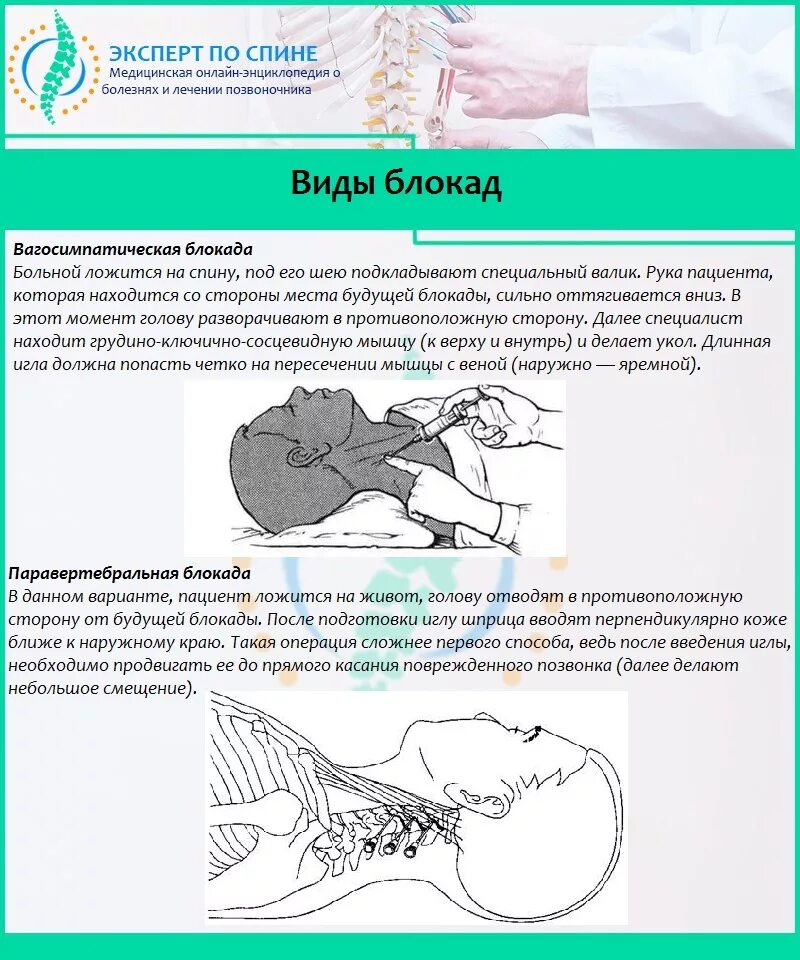 Блокада инструкция. Блокада в шейный отдел позвоночника последствия. Укол блокада от боли в шейном отделе позвоночника. Блокада шейного отдела позвоночника при остеохондрозе.