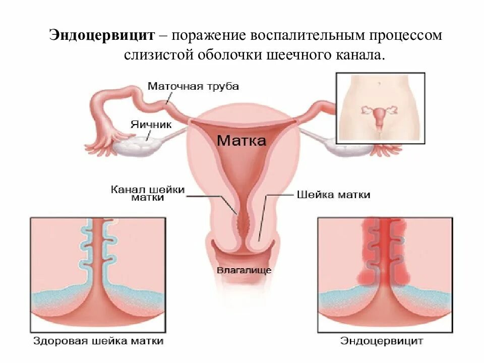 Эндоцервицит этиология. Неспецифический эндоцервицит. Хронический эндоцервицит. Экзоцервицит и эндоцервицит