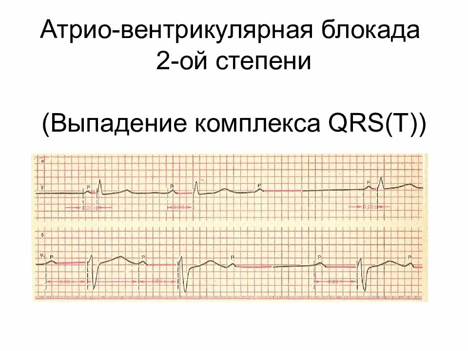 Комплекс блокада. Выпадение комплекса QRS на ЭКГ. АВ блокада 2 степени с выпадением QRS. Блокада ЭКГ выпадение. Блокада 2 степени ЭКГ Мобиц 2 выпадение QRS.