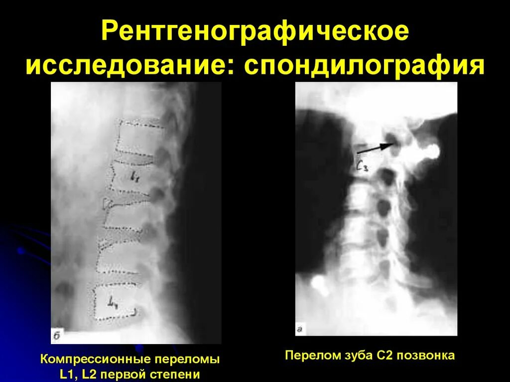 Рентгенография позвоночника в 2 х проекциях. Спондилография при переломе позвоночника. Спондилография шейного отдела. Функциональная спондилография. Спондилография поясничного отдела.