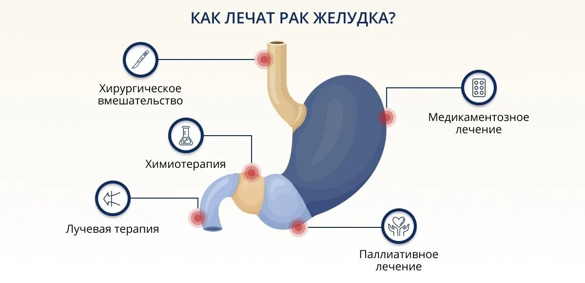 Стадии онкологии желудка. Локализация опухоли желудка. Желудок рисунок. Методы лечения онкологии желудка.
