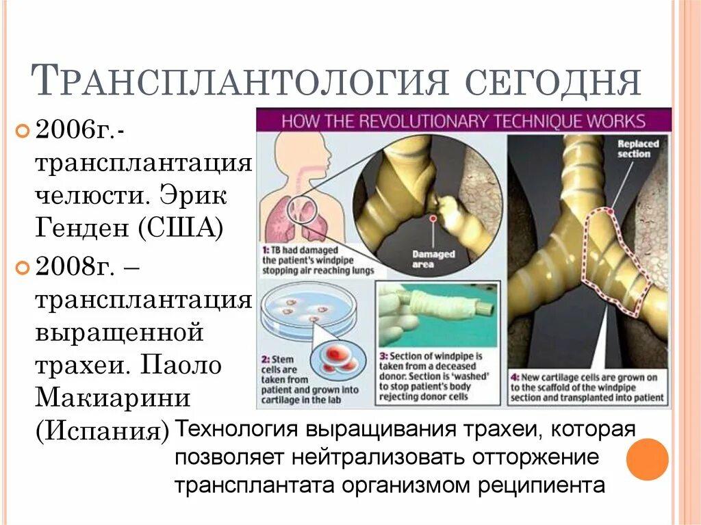 Трансплантация трахеи. Трансплантология органов. Трансплантация органов биология. Реципиент трансплантация