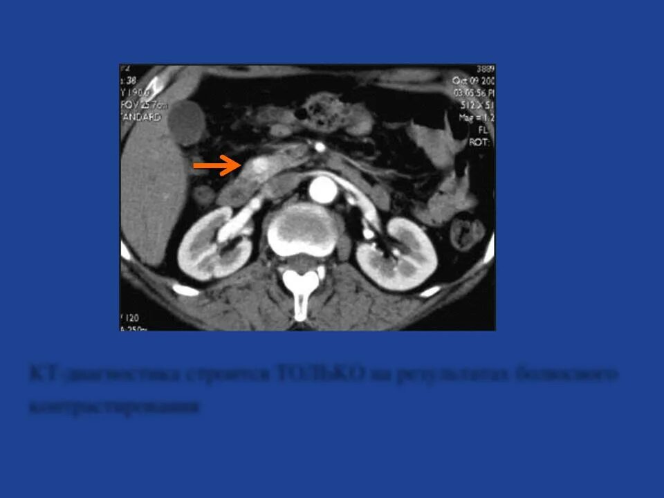 Мультипараметрическая мрт. Мрт малого таза сергея березина. Как подготовиться к мрт простаты. Кт пожилых. Заключение мрт предстательной железы.