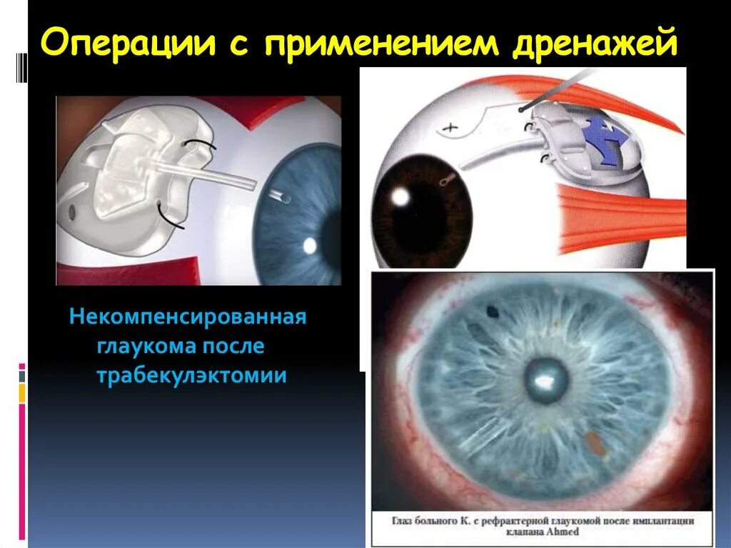 Что делать при глаукоме глаза. Хирургическая операция глаукомы. Операции при открытоугольной глаукоме.