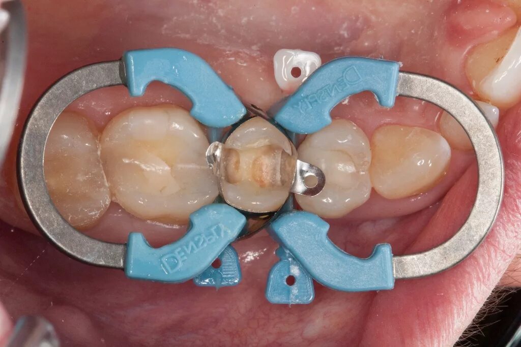 палодент матричная система. 1. Garrison матричная система стоматология. Garrison матричная система стоматология. матричная система в стоматологии гаррисон.