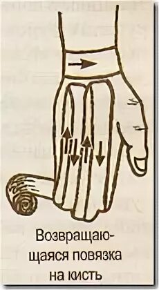 Техника наложения варежки. Возвращающаяся повязка на кисть. Повязка варежка. Наложение повязки на кисть варежка. Возвращающаяся повязка на кисть варежка.
