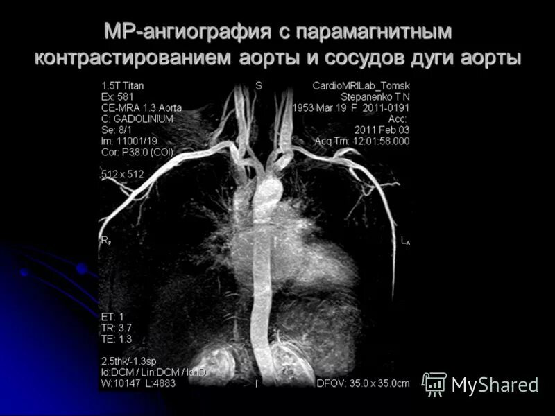 Мскт аортография. Магнитно-резонансная ангиография аорты. аневризма грудной аорты аортография. кт ангиография грудного отдела аорты. аневризма аорты грудного отдела на мрт.