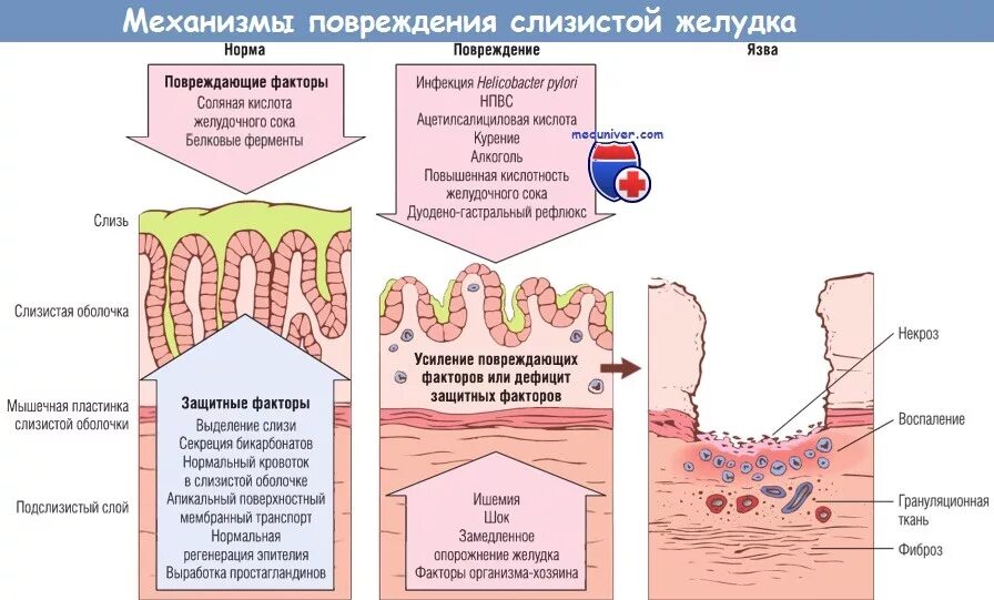 Барьер слизистая оболочка. Механизм повреждения слизистой оболочки желудка. Факторы агрессии на слизистую оболочку желудка. Факторы защиты слизистой ЖКТ. Основные повреждающие факторы слизистой оболочки желудка.