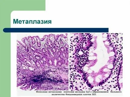 Пролиферация железистого эпителия nilm