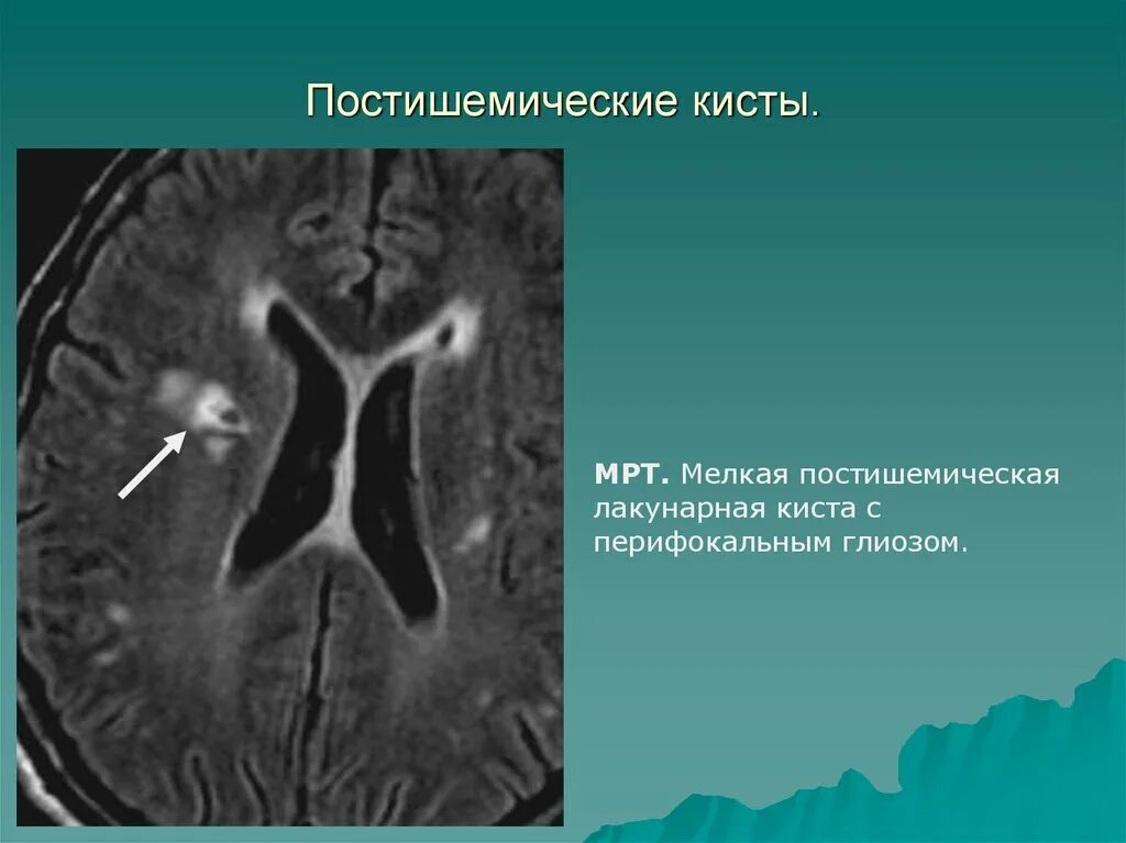 Постишемические изменения мозга. Постихимические кисты. Постишемические кисты головного мозга на мрт.