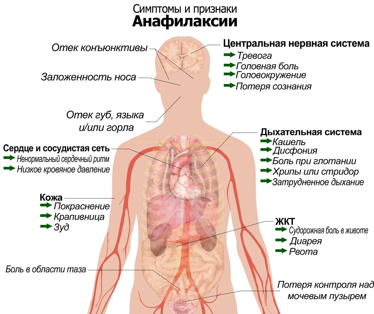 Анафилактический шок аллерген. Проявления анафилаксии. Анафилактический ШОК симптомы.