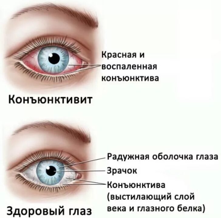 Назовите причины конъюнктивита какую помощь надо оказать. Конъюнктивит мешок конъюнктивальный мешок. Воспалился глаз конъюнктивит. Конъюнктивит верхнее веко.