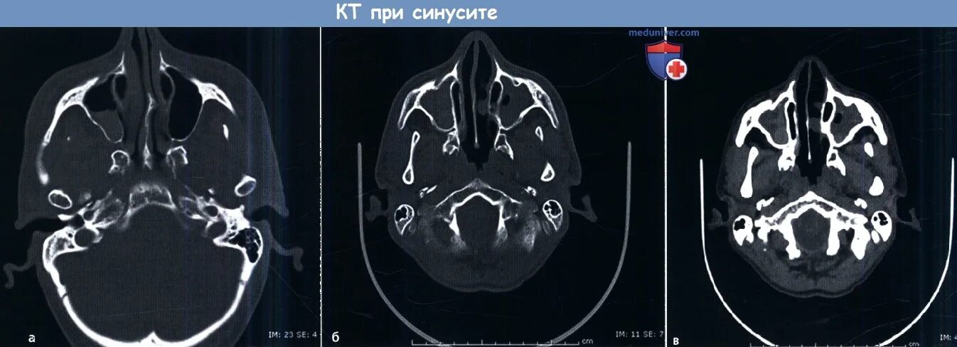Синусит на кт. Хронический пансинусит кт. хронический синусит на кт. хронический гиперпластический синусит кт.