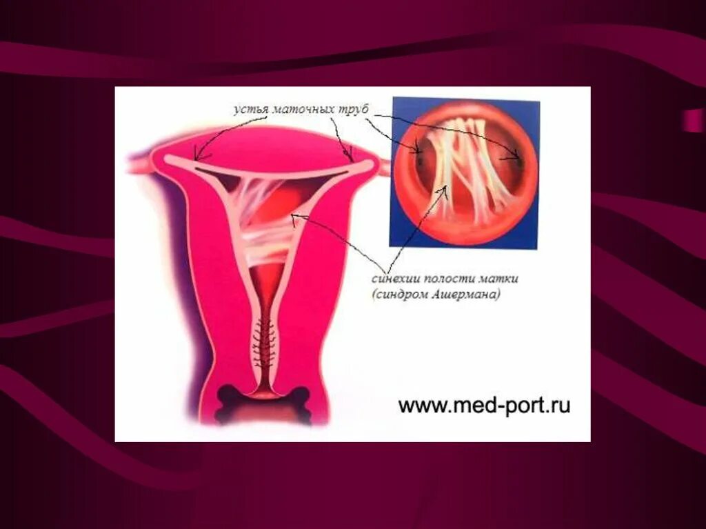 Внутриматочная синехия синдром ашермана. Синдром ашермана это. Маточная форма аменореи. Формы аменореи. Внутриматочные синехии на узи что это такое.