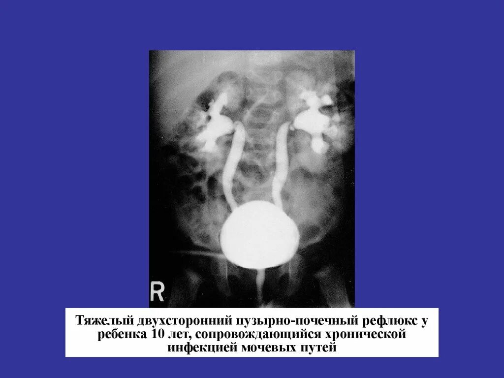 Необструктивный хронический пиелонефрит с рефлюксом. Хронический интерстициальный нефрит УЗИ. Пузырно-мочеточниковый рефлюкс почка на УЗИ. Лоханочно почечный рефлюкс это. Туболоинстрецианальный нефрит.