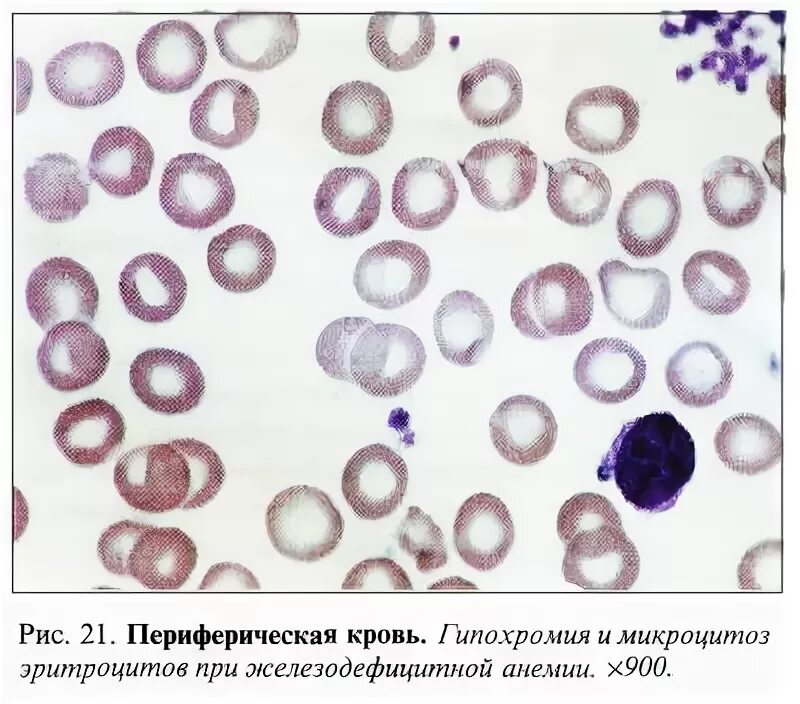 Гипохромия железодефицитная анемия. При железодефицитной анемии гиперхромия эритроцитов. Гипохромия эритроцитов картина крови. Гипохромия микроцитоз. Железодефицитная анемия в микроскопе.