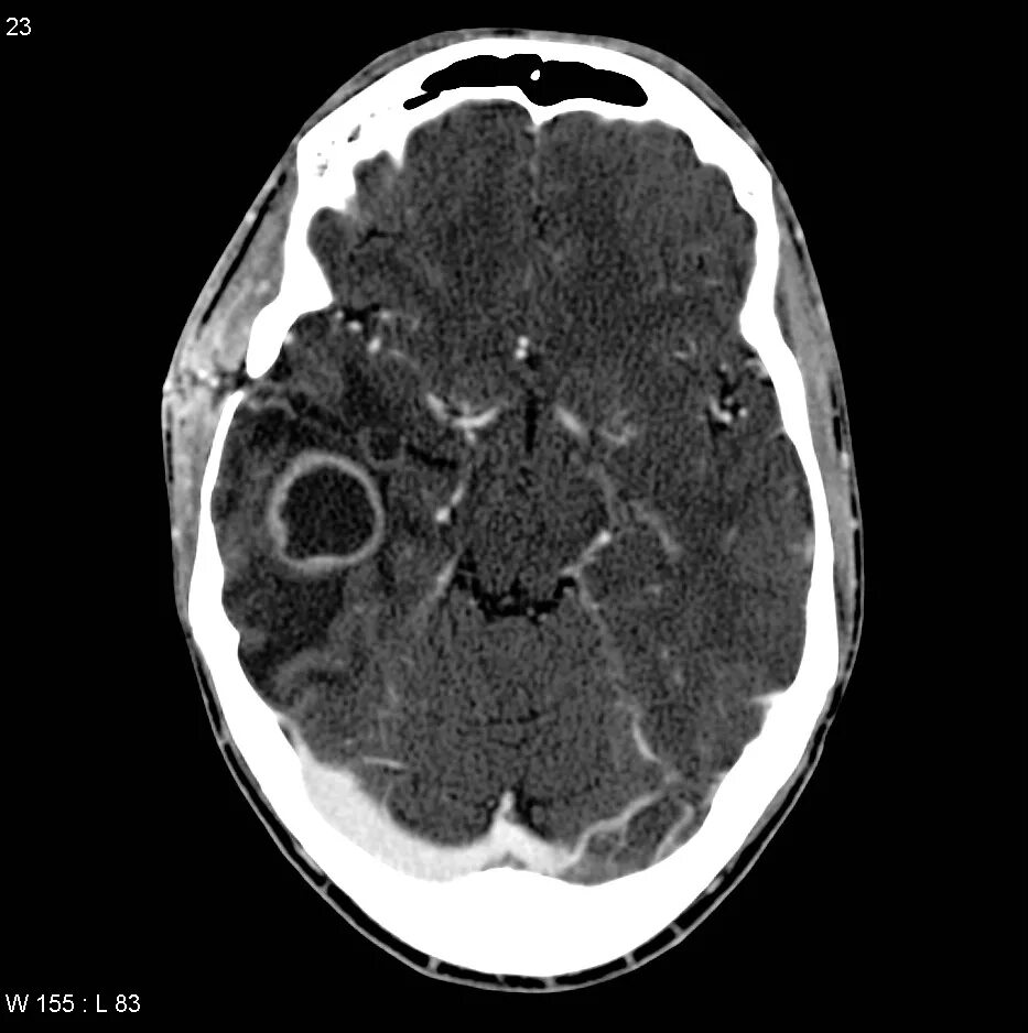 Абсцесс мозга. Абсцесс головного мозга кт. Кт томограмма абсцесса головного мозга. Абсцесс головного мозга мрт. Субдуральный абсцесс мозга кт.