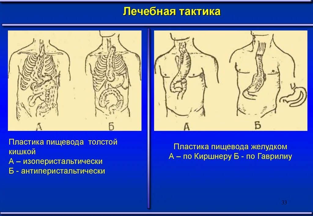 Искусственный пищевод. Пластика пищевода по Киршнеру. Современные способы пластики пищевода. Пластика пищевода толстой кишкой. Операция пластики пищевода.