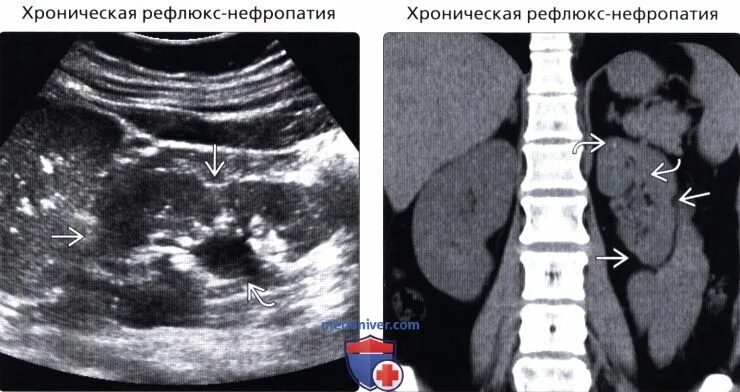 Уменьшение размеров почки. Уменьшение размеров почки на узи. кортико-медуллярная дифференциация почек что это. уменьшение почки в размерах при. кортико медуллярная зона почки.