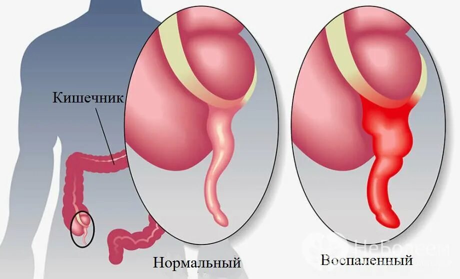 Почему воспаляется аппендицит. Почему воспаляется аппендицит
