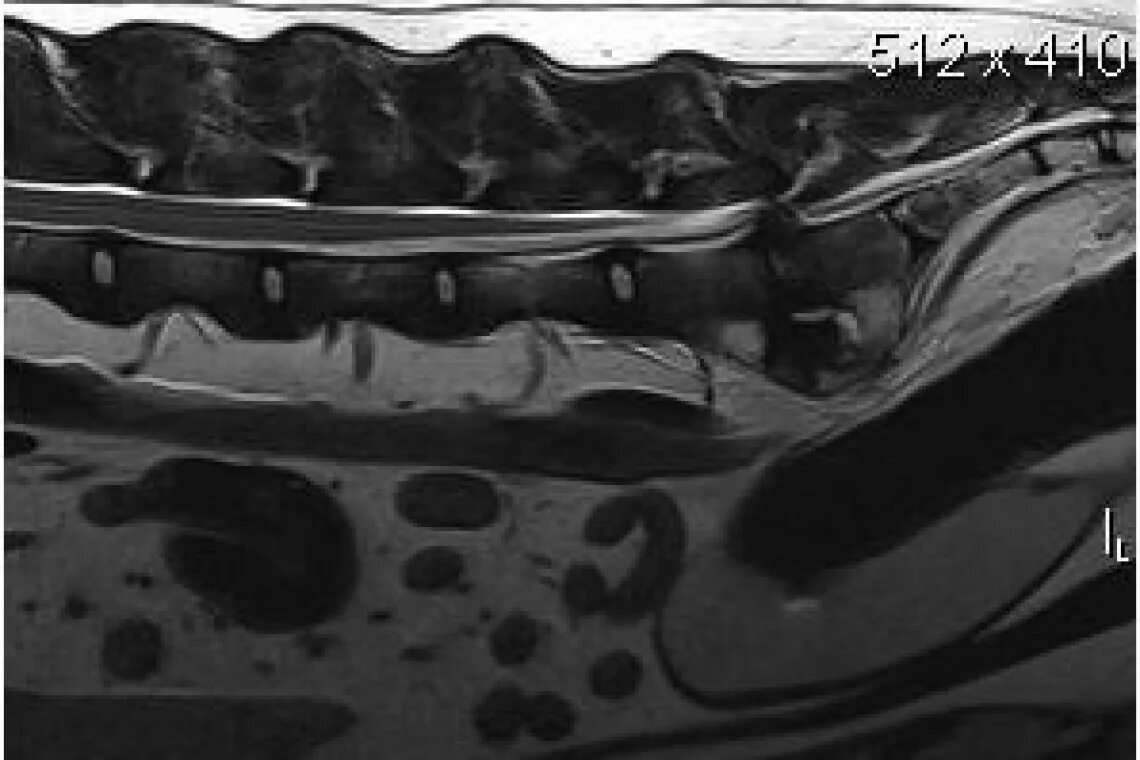 Люмбосакральный стеноз. Дегенеративный люмбосакральный стеноз. Люмбально сакральный стеноз у собак. Синдром кауда эквина у собак. Крестцовый стеноз